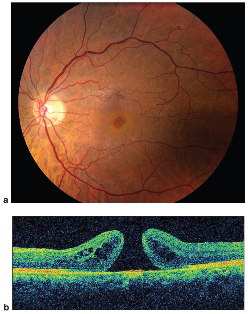 http://www.neworleansretinaspecialists.com/wp-content/uploads/macular-hole-810x1024.jpg